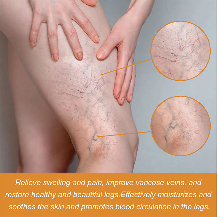 Varicose Veins Health Care Paste
