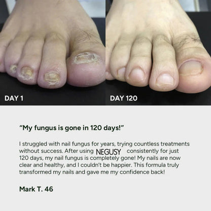 Nail Fungus Treatment Gel