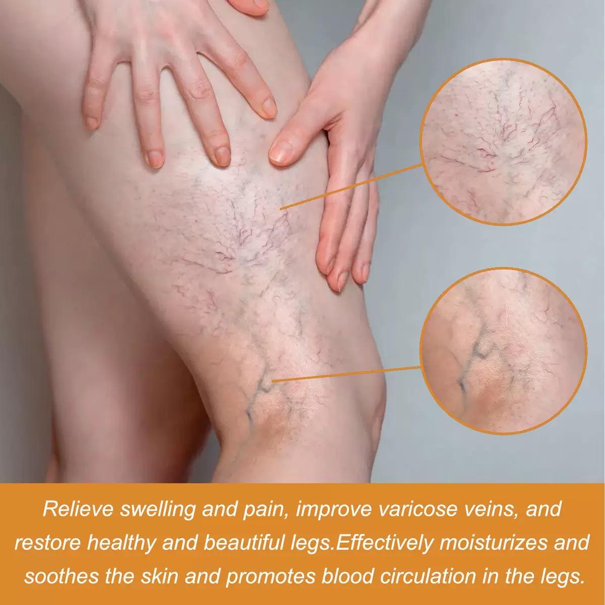 Varicose Veins Health Care Paste