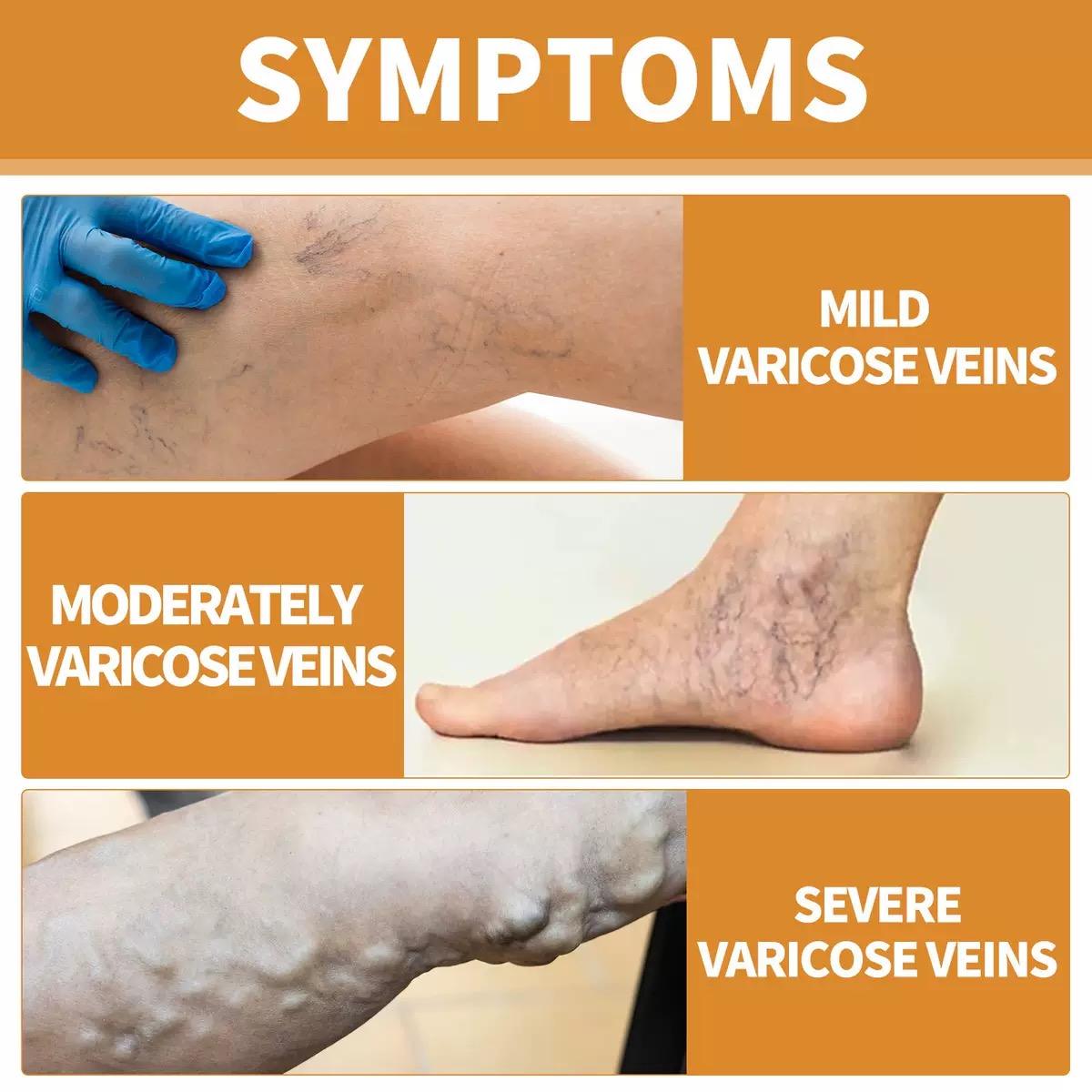 Varicose Veins Health Care Paste
