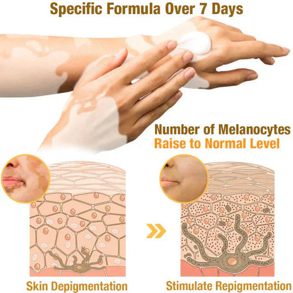 Vitiligo Bee Venom Treatment Cream