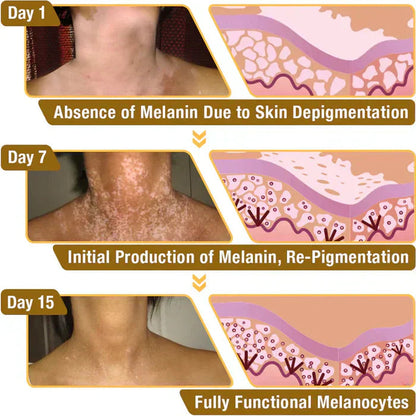 Vitiligo Bee Venom Treatment Cream