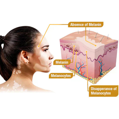 Vitiligo Bee Venom Treatment Cream